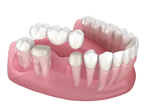 3D model of a dental bridge from Capitol Square Dental 