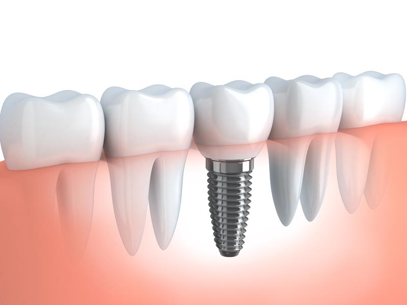 Dental Implants  Columbus Ohio 