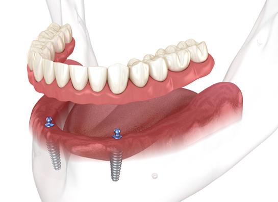 Implant-supported dentures  Columbus Ohio 
